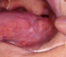 舌癌組織内照射