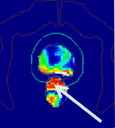 3次元放射線生物学的Gamma分布（色付：合格した箇所、白：不合格した箇所）