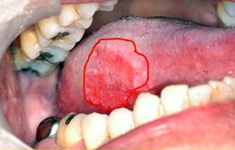 舌癌の肉眼形状